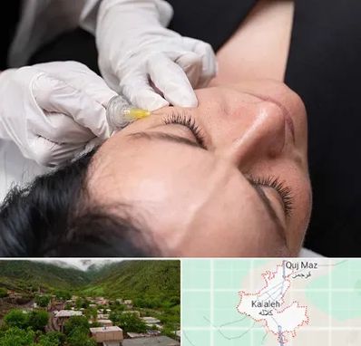 کربوکسی تراپی در کلاله