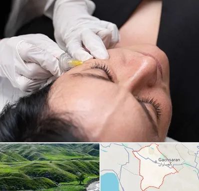 کربوکسی تراپی در گچساران