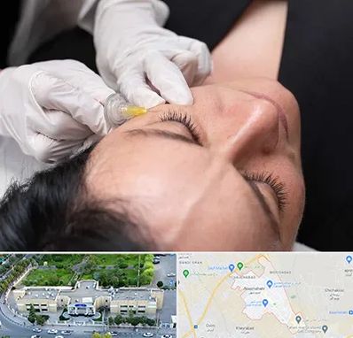 کربوکسی تراپی در نسیم شهر