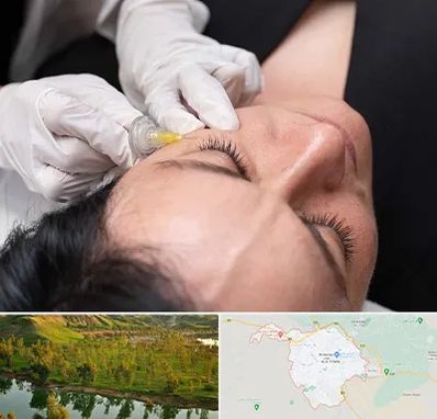 کربوکسی تراپی در بهبهان