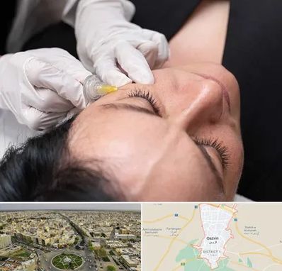 کربوکسی تراپی در قزوین