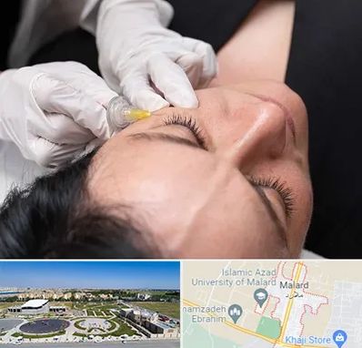 کربوکسی تراپی در ملارد