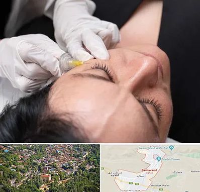 کربوکسی تراپی در دماوند