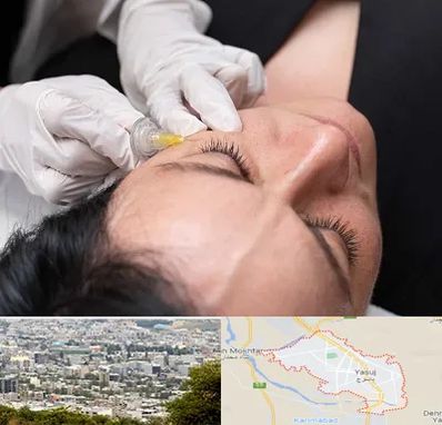 کربوکسی تراپی در یاسوج