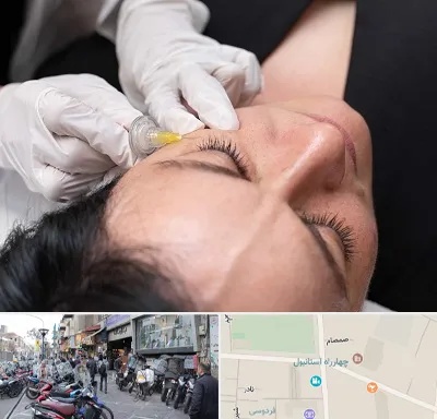 کربوکسی تراپی در چهارراه استانبول