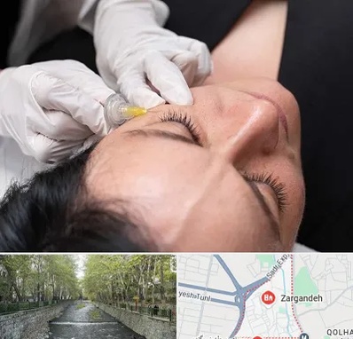 کربوکسی تراپی در زرگنده