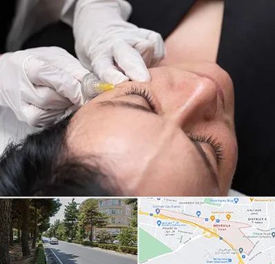 کربوکسی تراپی در مهرویلا کرج