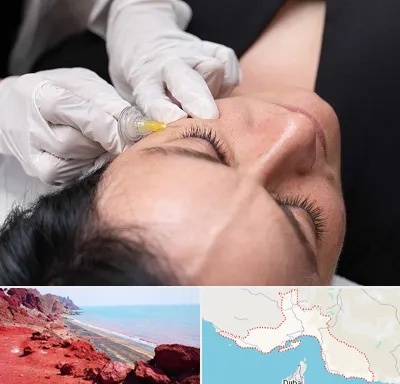 کربوکسی تراپی در هرمزگان