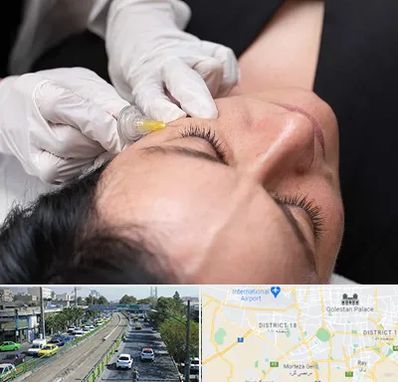 کربوکسی تراپی در جنوب تهران 