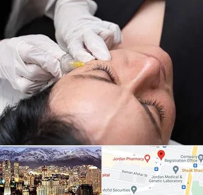 کربوکسی تراپی در جردن 