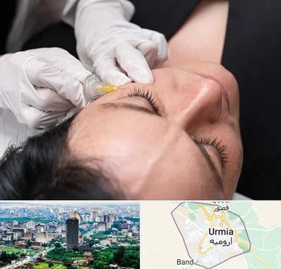 کربوکسی تراپی در ارومیه