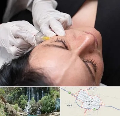 کربوکسی تراپی در شیروان