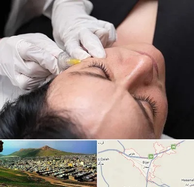 کربوکسی تراپی در بیجار