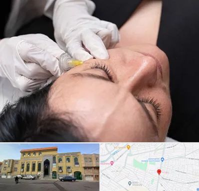 کربوکسی تراپی در زنبیل آباد قم