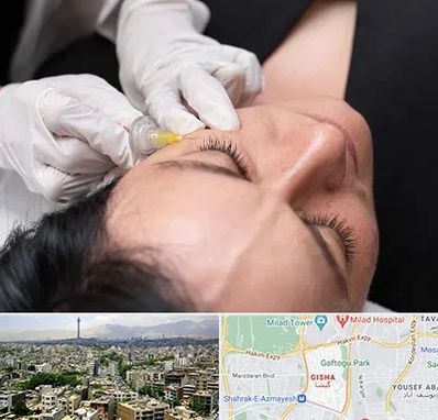 کربوکسی تراپی در گیشا 