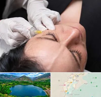 کربوکسی تراپی در رودبار