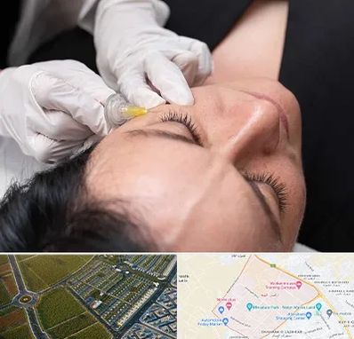 کربوکسی تراپی در الهیه مشهد