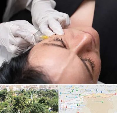 کربوکسی تراپی در منطقه 13 تهران 