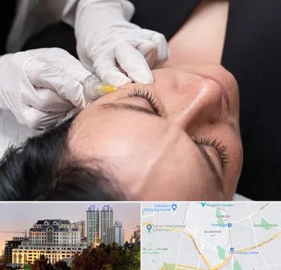 کربوکسی تراپی در فرشته 