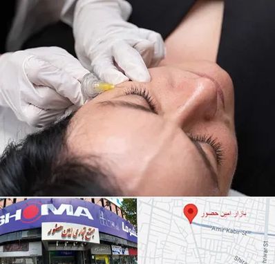 کربوکسی تراپی در امین حضور