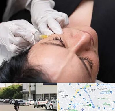 کربوکسی تراپی در قدوسی شرقی شیراز