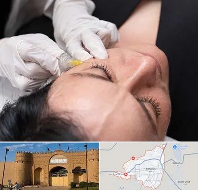 کربوکسی تراپی در ایرانشهر