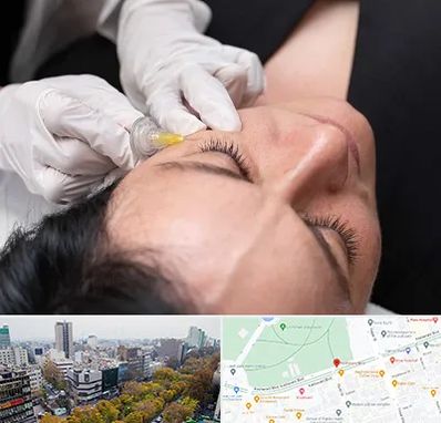 کربوکسی تراپی در بلوار کشاورز 