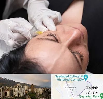 کربوکسی تراپی در زعفرانیه 