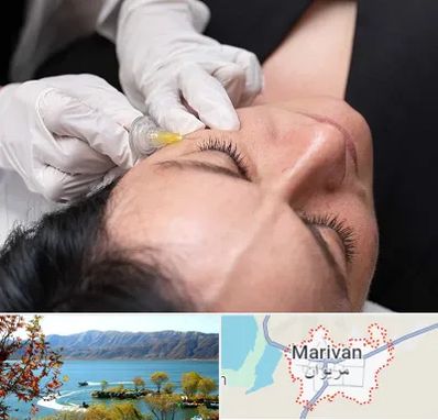 کربوکسی تراپی در مریوان