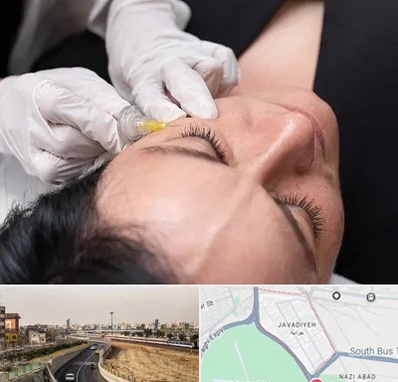 کربوکسی تراپی در جوادیه