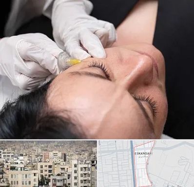 کربوکسی تراپی در اسکندری