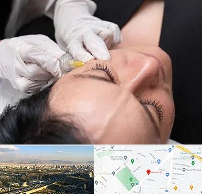 کربوکسی تراپی در هنگام 