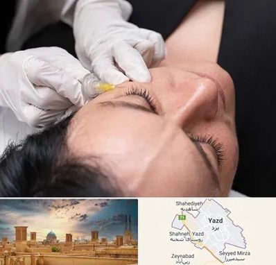 کربوکسی تراپی در یزد