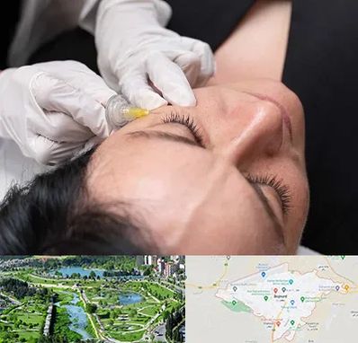 کربوکسی تراپی در بجنورد