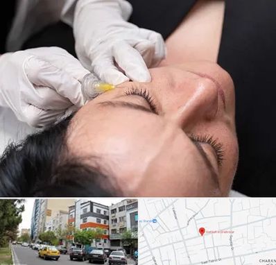 کربوکسی تراپی در هفده شهریور تبریز