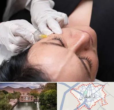 کربوکسی تراپی در دامغان
