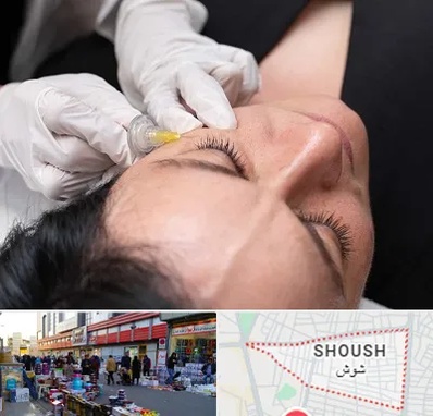 کربوکسی تراپی در شوش