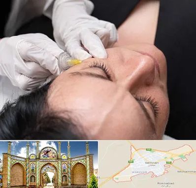 کربوکسی تراپی در سمنان