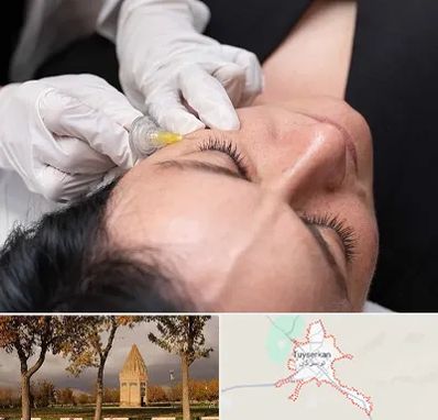 کربوکسی تراپی در تویسرکان