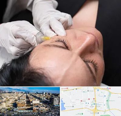 کربوکسی تراپی در شهرک راه آهن