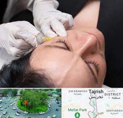 کربوکسی تراپی در تجریش 