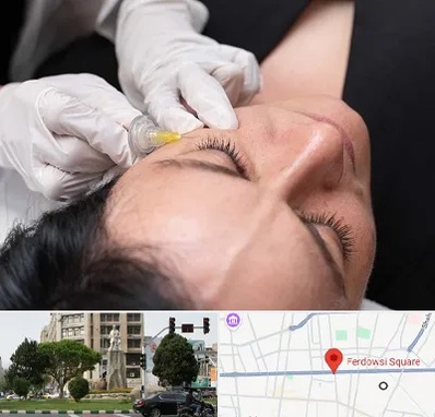 کربوکسی تراپی در میدان فردوسی تهران
