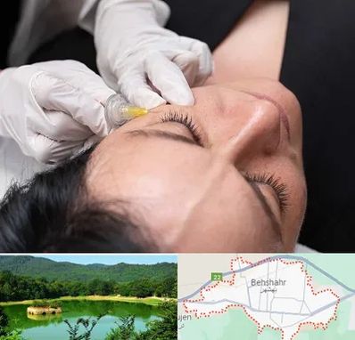 کربوکسی تراپی در بهشهر