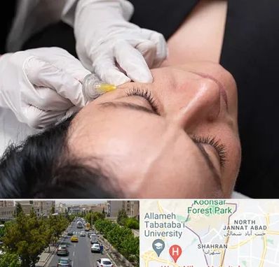 کربوکسی تراپی در شهران 