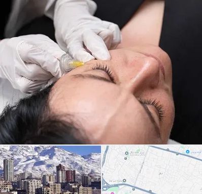 کربوکسی تراپی در ازگل