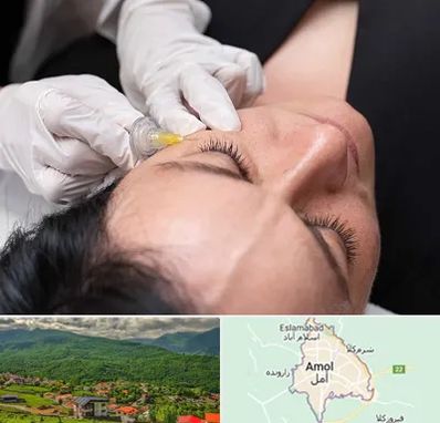 کربوکسی تراپی در آمل