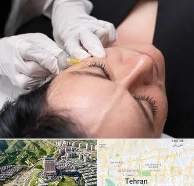 کربوکسی تراپی در شمال تهران 