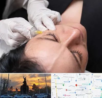 کربوکسی تراپی در میدان حر 