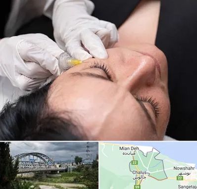 کربوکسی تراپی در چالوس