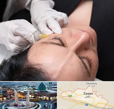 کربوکسی تراپی در زنجان